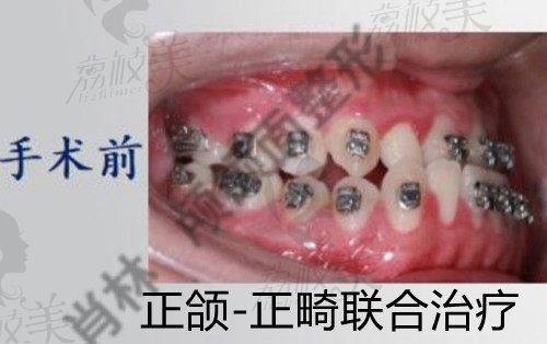 重庆北部宽仁肖林做正颌手术值得一赞，骨性凸嘴矫正仅38200元起