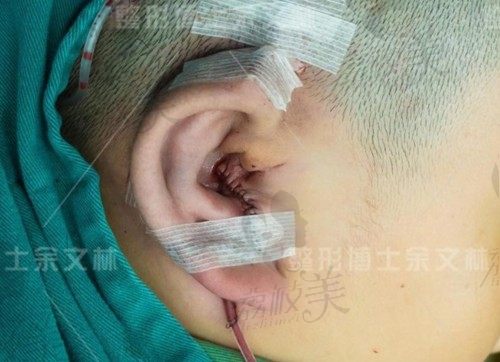 广州高尚做耳再造手术怎么样?余文林做小耳畸形的范例及价格来了
