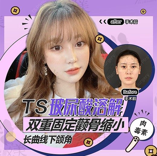 韩国TS整形外科医院，重塑面部轮廓，气质提升新高度！