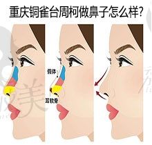 重庆铜雀台周柯做鼻子怎么样？做鼻子的风格如何来看看真实评价