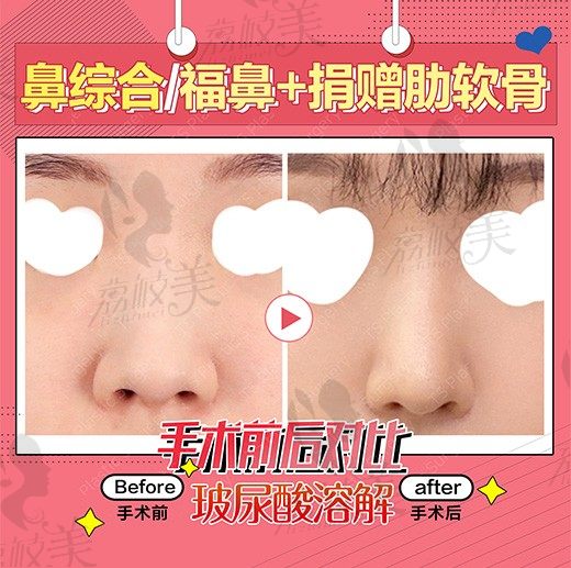我在韩国TS整形做了鼻综合术，从此改善了我的福鼻！