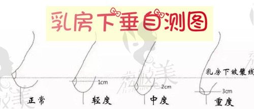 上海胸部提升要多少钱?上海艺星乳房下垂矫正3万元起(含范例)