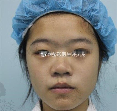 上海许炎龙做假体隆鼻如何,跟李健比哪个更好！
