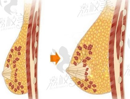 速求上海自体脂肪隆胸比较好的医生，选伊莱美顾新安医师准没错！
