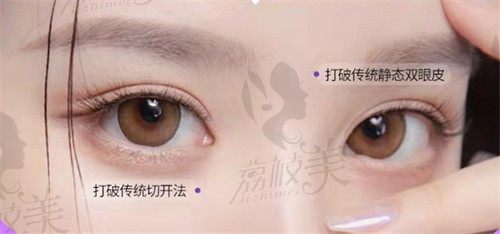 杭州维多利亚双眼皮修复实例招募，动态美眼修复仅需15800元起