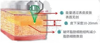 中山溶脂医院必问爱思特，吸脂费用，技术大曝光