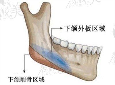 上海九院柴岗削下颌骨风格自然，长曲线截骨价格仅需50000元起