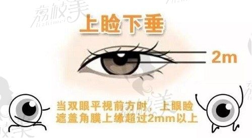 北京睐美安王振军做上睑下垂技术强,CFS联合筋膜鞘修复42000元起