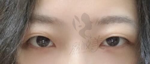 八大处杨庆华双眼皮怎么样?据说她做双眼皮和眼袋技术挺不错