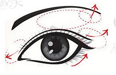 成都杨迪做双眼皮修复技术如何？跟虞冬梅谁的审美更好？