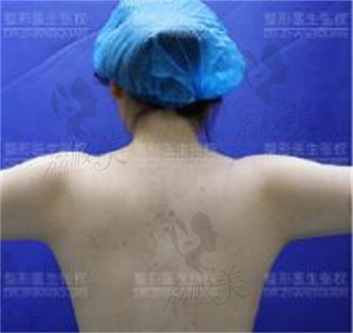 上海张权吸脂如何,这有腿部+肩背+面部吸脂实例你来看