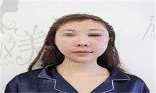北京李晓东面部提升案例曝光,快看李晓东面部提升怎么样