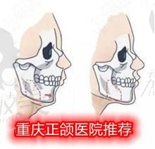 重庆正颌手术医院推荐,这两医院做骨性凸嘴和地包天都不错