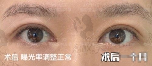 北京美莱哪个医生做眼睛好？推荐叶宇双眼皮口碑不错！