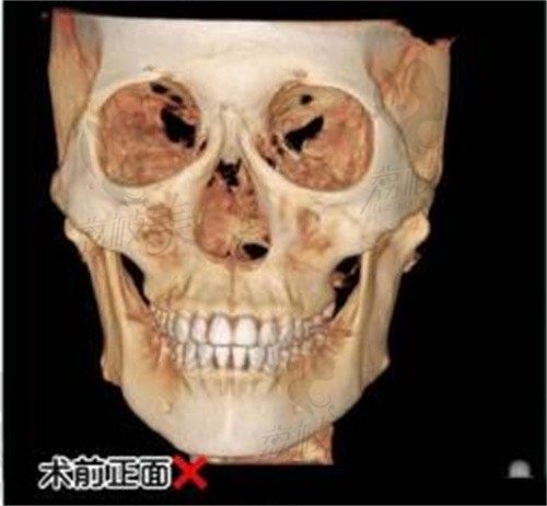 崔宇景磨骨价格表上新,下颌角截骨3w起实例对比惊艳