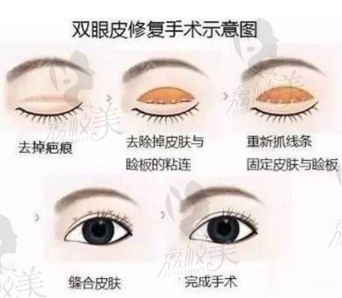 北京闫迎军双眼皮修复好不自然是真的吗？从真实情况来鉴别！