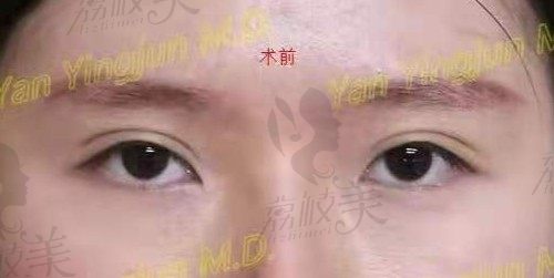 北京闫迎军双眼皮修复排名靠前，修复双眼皮18000元起