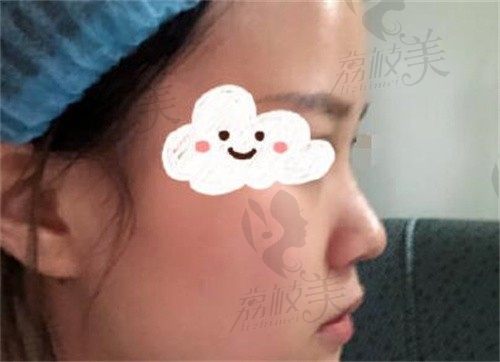 上海鼻子专家赵延锋案例惊艳,膨体隆鼻费用不到3W