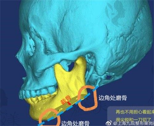 上海九院柴岗磨骨技术好吗,下颌角手术七万起