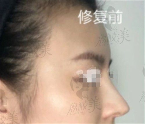 赵延峰是国内修复鼻子好的医生,肋骨鼻修复案例好惊艳!