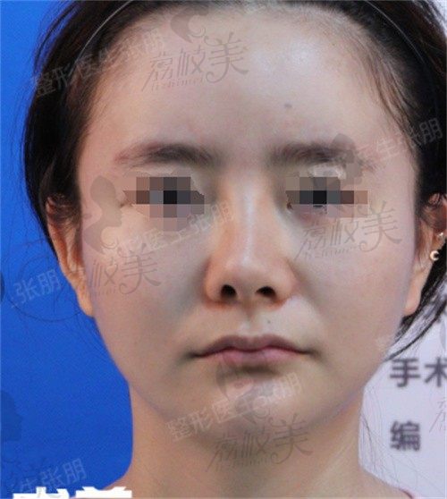 上海张朋做鼻子怎么样,鼻修复案例惊艳恢复快！
