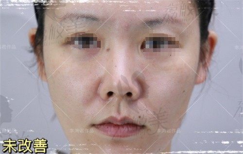 上海李鸿君做鼻子多是自然微翘,半肋鼻综合修复6W起即刻效果明显