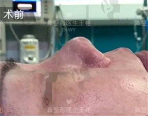 上海王艳做异体骨隆鼻4w起,术后鼻型自然还不用取肋