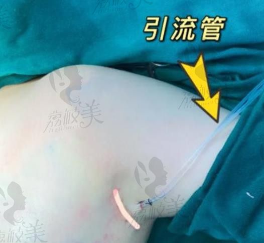 宁波艺星隆胸怎么样，朱继锋假体隆胸不插管是真的吗？