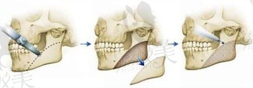 徐威强医生做磨骨技术怎么样，听说徐威强做下颌角截骨只要3万多
