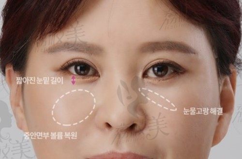 韩国大眼睛整形医院做去眼袋很不错,实现中面部提升仅1.5万元起