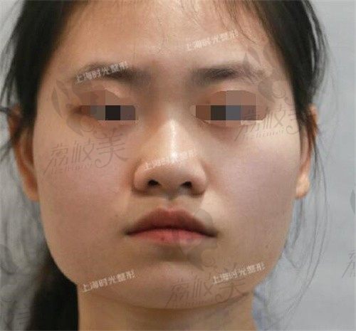 上海何晋龙颧骨+下颌角磨骨83300元起,术后6个月脸小了一圈