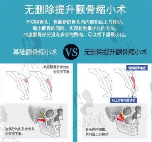 韩国面部轮廓手术技术比拼,菲斯莱茵跟韩国1%(百分之一)整形难分伯仲