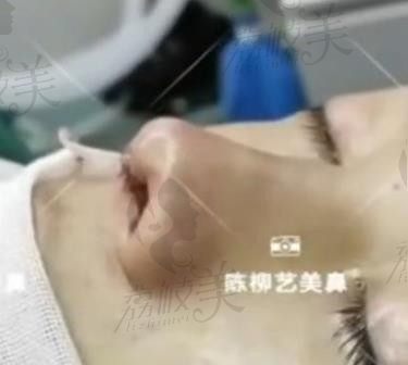 陈柳艺做的鼻子案例挺翘自然，肋软骨隆鼻19800元起