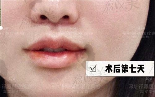 深圳福雅胡俊杰医生人中缩短术真赞，免拆线又减龄综合打造M唇