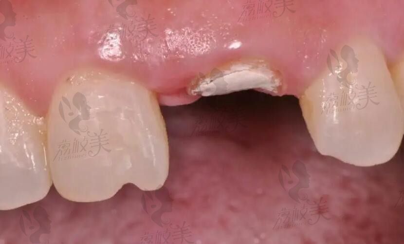 如果牙根烂了拔掉后必须种牙吗？听说良心医生不建议种植牙镶牙