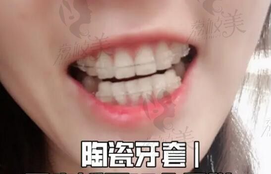 矫正牙齿经验分享，看过了25岁较好不要矫正牙齿是不是真的？