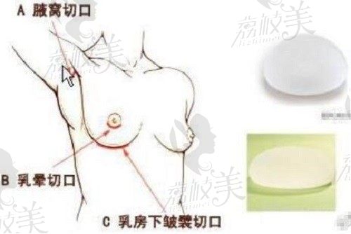 北京八大处隆胸医生推荐刘春军,隆胸技术好口碑赞价格8万起