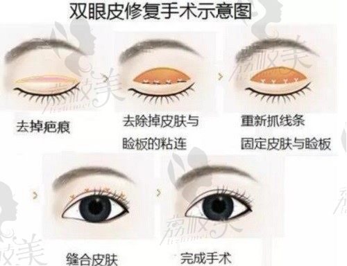 北京嘉禾整形医院修复双眼皮口碑真不错,孙景波双眼皮修复技术赞