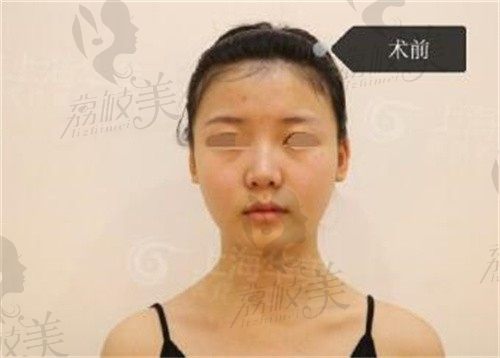 上海张朋做鼻子怎么样,耳软骨鼻综合三万多依案例看不贵！
