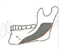 李湘原做下颌角怎么样,长曲线截骨平滑且提升下颌缘