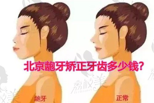 北京龅牙矫正牙齿多少钱，请看排名前五医院牙齿矫正价格表