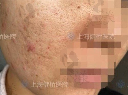 上海健桥疤痕修复中心怎么样好不好,是治疗瘢痕疙瘩正规医院吗？