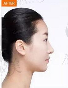 刘先超做鼻子怎么样,他做的阿芙洛美鼻是肋骨鼻吗