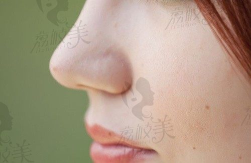 杭州时光胡斌做鼻子怎么样？根据鼻整形技术+做鼻子风格判断
