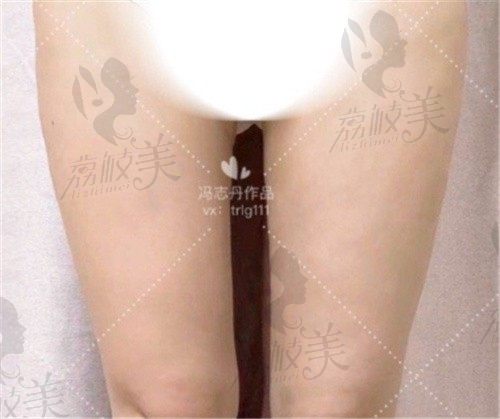 杭州同荣丽格冯志丹吸脂怎么样？超脂塑瘦大腿风格自然技术好