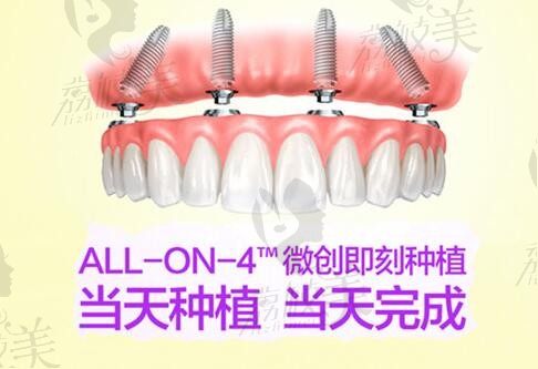 北京冠美平乐口腔ALL-ON-FOUR韩国登腾种植牙保护临牙、咀嚼效率高