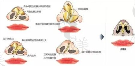 李信鋒鼻修復(fù)真的做的好嗎？李信鋒和朱燦誰(shuí)修復(fù)鼻子技術(shù)更厲害？