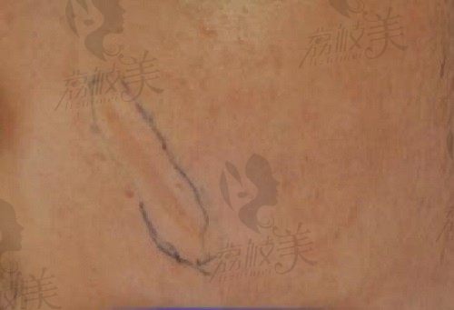 北京凹陷疤痕修复可选国丹医院,疤痕治疗口碑好,凹陷疤痕优惠价200元起1c㎡