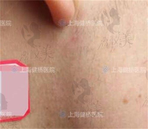 上海健桥疤痕医院是公立医院吗?祛疤技术怎么样早知道！