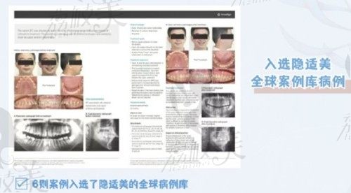 深圳友睦齿科佘东育医生做牙齿矫正技术靠谱,尤其是骨性凸嘴矫正